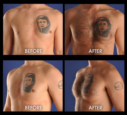 Before After Pectoral Implants Gravity Medical Spa