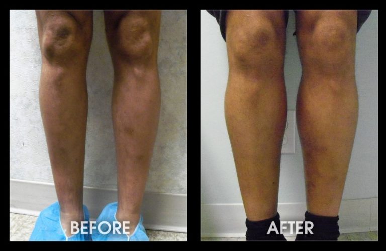 Calf Augmentation Orange County Body Implants San Juan Capistrano