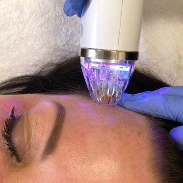 microneedling patient