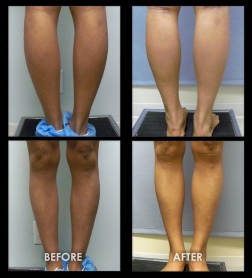 beforeaftercalfimplants13 Gravity Medical Spa