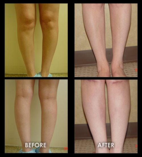 beforeaftercalfimplants14 Gravity Medical Spa