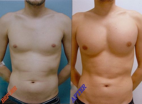 Before After Pectoral Implants 01 Gravity Medical Spa