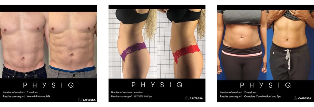 Physiq Body Contouring Treatments San Juan Capistrano